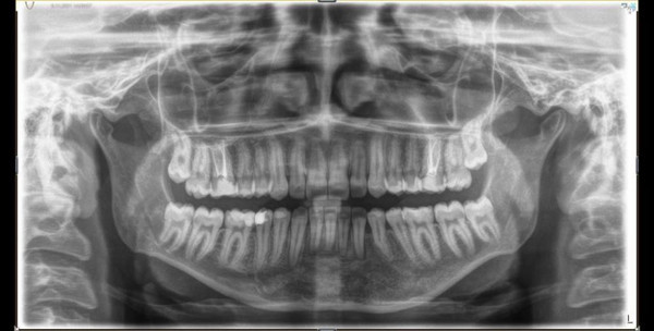 Eskişehir'de yüzüne dolgu yaptırmak istedi! Çenesinde çıkan şeyi öğrenince şaştı kaldı: 10 dişini kaybedebilirdi - Resim: 2