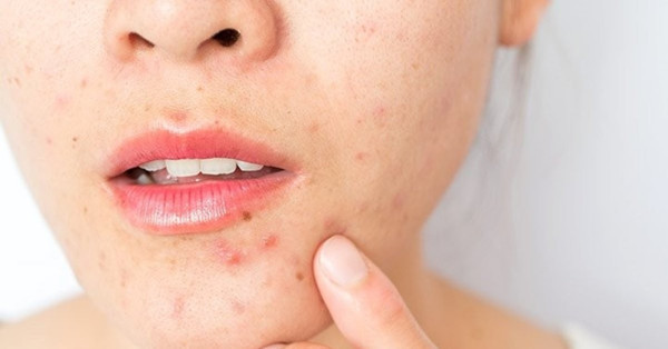 Uzmanlar uyardı! Ölüm üçgeni'nde çıkan sivilcelere dikkat - Resim: 2