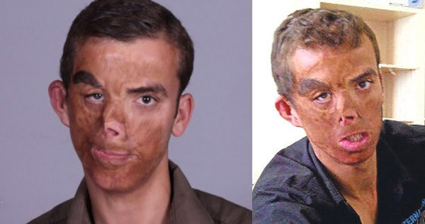 Türkiye'nin ilk yüz nakliydi! Uğur Acar'ın son hali görenleri şaşkına çevirdi - Resim: 1