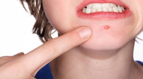 Uzmanlar uyardı! Ölüm üçgeni'nde çıkan sivilcelere dikkat - Resim: 3