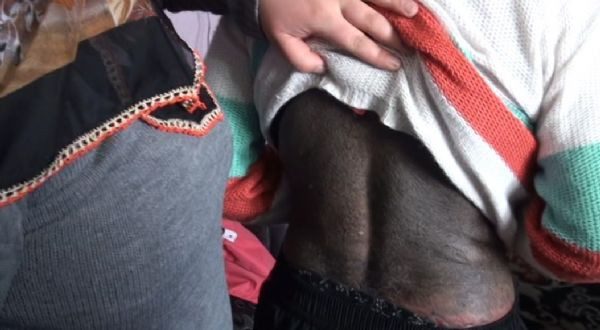 Cilt kanserine yakalandı - Resim: 2