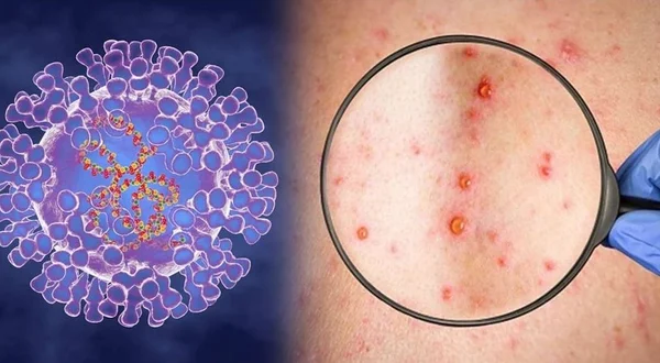 Maymun çiçeği virüsü sadece cinsel yolla mı bulaşıyor? Uzmanlar detaylarıyla açıkladı - Resim: 4