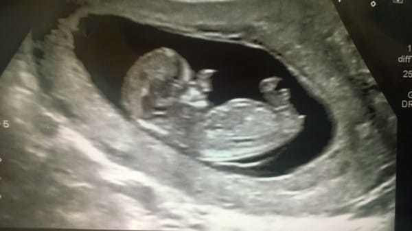 Bebeği bu halde dünyaya geldi görenler gözlerine inanamadı 3 yıl sonra... - Resim: 2