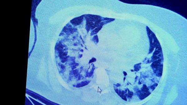 Fark ortaya çıktı! Koronavirüslü hastalarının görüntüsü görenleri şok etti - Resim: 3