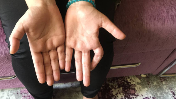 Bayburt'ta teli çekerken kopardılar hayatı kabusa döndü! 20 bin TL gerekiyor - Resim: 0