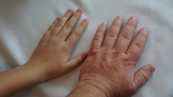 Ayakkabı ayağınıza olmuyorsa dikkat! 5 kişiden 1’inde görülüyor: Kısırlığa neden oluyor - Resim: 0