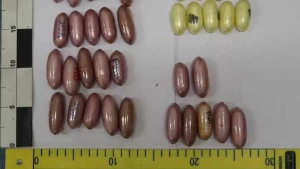 Tomografide ortaya çıktı! Mideden çıkanları gören şaştı kaldı - Resim: 0