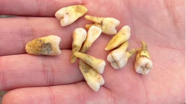 Yeni kriz patlak verdi! Kendi dişlerini çekmeye başladılar: Her gün ağrı kesici almak zorunda kalıyorum - Resim: 1