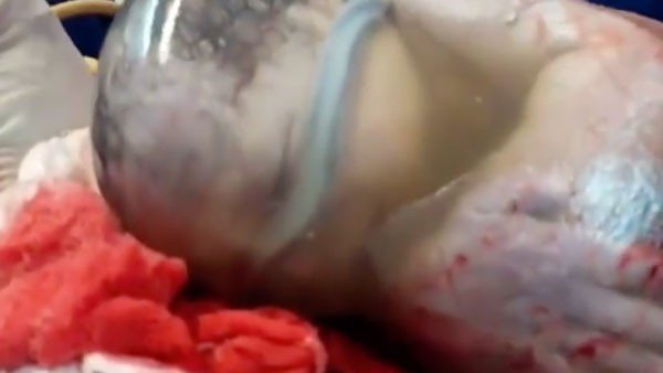 Bebek bu halde dünyaya geldi doktorlar şoke oldu - Resim: 3