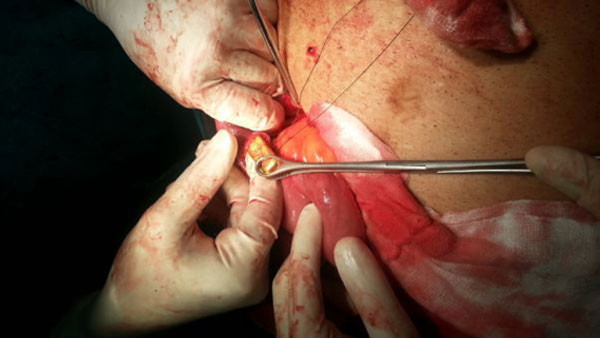 Midesinden çıkan altınlar görenleri şok etti! - Resim: 3