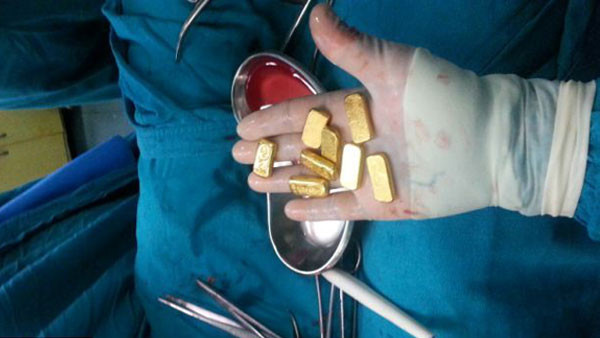 Midesinden çıkan altınlar görenleri şok etti! - Resim: 4