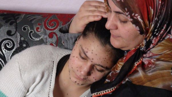 Cilt kanserine yakalandı - Resim: 3