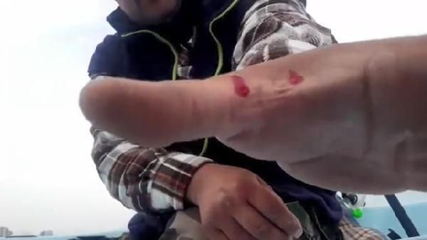 Trakonya balığını eline aldı 30 saniye sonra hastanelik oldu! "Önce acı sonra uyuşma hissettim" - Resim: 3