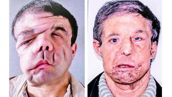 Kocası yüzüne kimyasal madde attı ikinci kez yüz nakli yapıldı! İşte son hali - Resim: 2