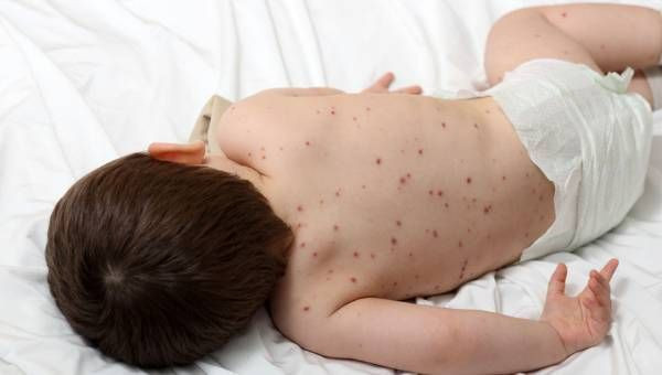 İstanbul'da yeni salgın patladı! Kızamık nedeniyle çocuklar ölmeye başladı! 'Aşı yaptırın' uyarısı geldi - Resim: 1