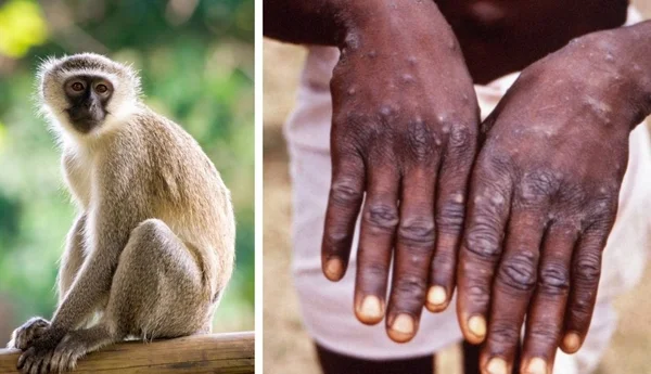 Maymun çiçeği virüsü sadece cinsel yolla mı bulaşıyor? Uzmanlar detaylarıyla açıkladı - Resim: 3