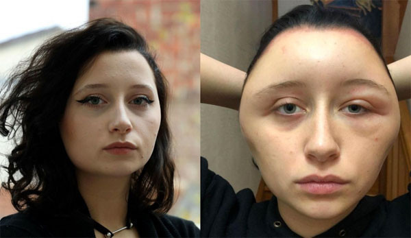 Saç boyası genç kızı öldürüyordu yaşadıkları şeyler ve görüntüsü korkunç - Resim: 1