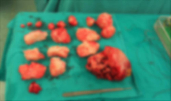 İstanbul'da şişkinlik sanıp hastaneye gitti gerçeği öğrenince şok oldu!! 2 saatte çıkarıldı - Resim: 0