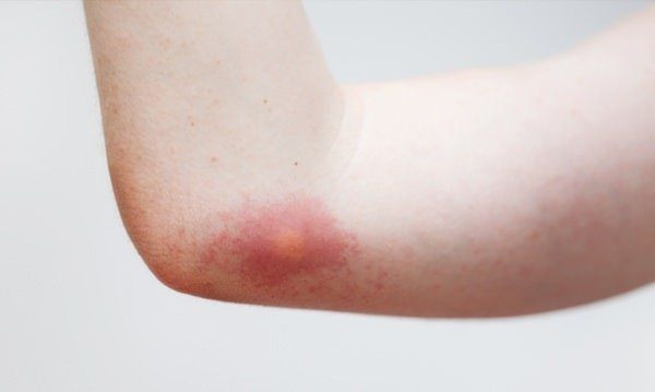 Ciltte morarma sebepleri morluklar nasıl geçer? - Resim: 3