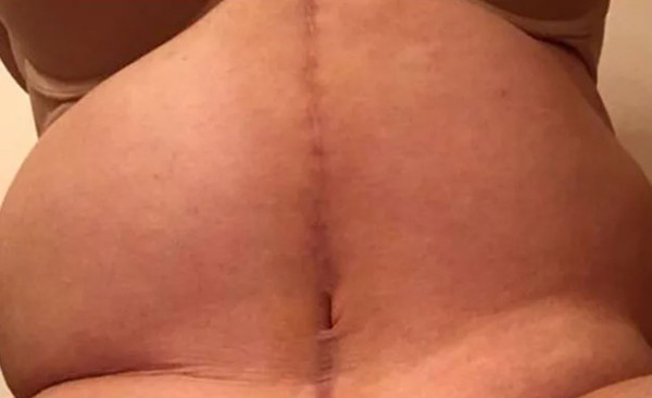 'Vücudun kum saati gibi olacak' denilmişti! Oturamaz hale geldi - Resim: 1