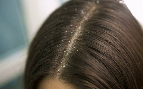 Kepek probleminiz varsa bu alışkanlıkları derhal bırakın - Resim: 0