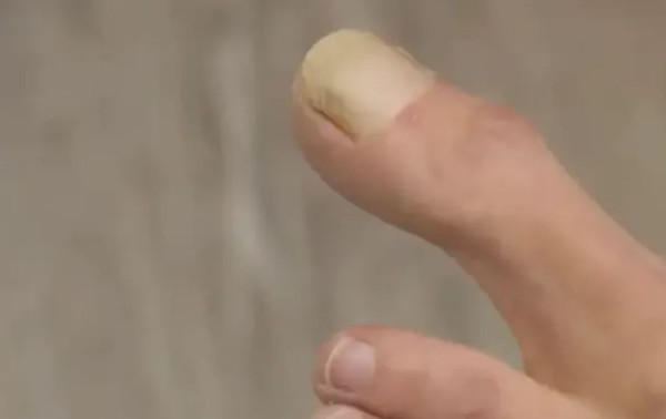 Ayak parmağı doktoru bile şaşkına çevirdi: İlk defa görüyorum - Resim: 0