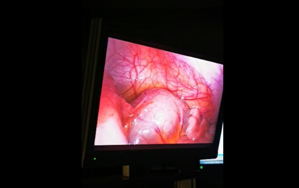 Sivas'ta karın ağrısıyla gitti! Gerçeği öğrenince şaştı kaldı: Hiçbir hastane cesaret edemedi - Resim: 1