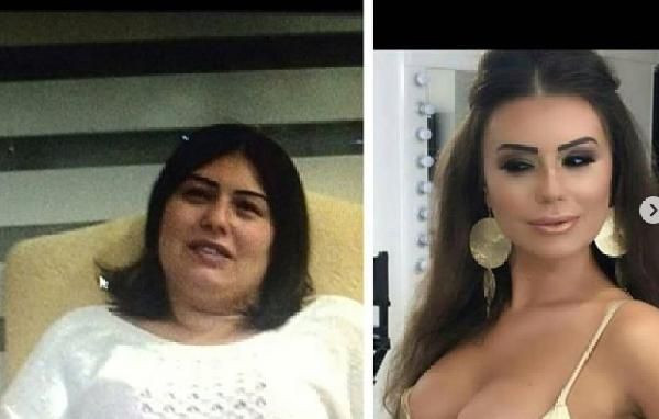 22'nci kez estetik ameliyatı oldu kadınlara mesaj yolladı - Resim: 3