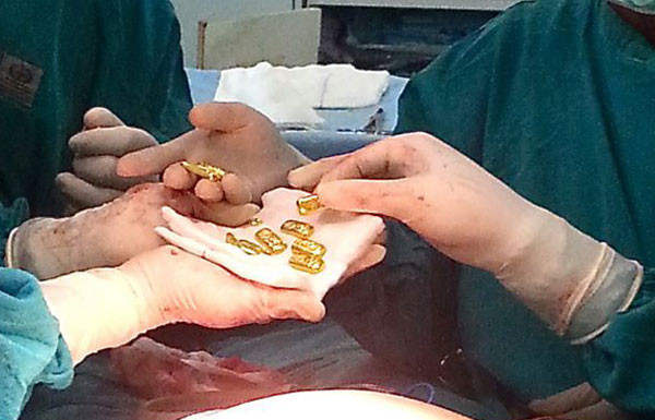 Midesinden çıkan altınlar görenleri şok etti! - Resim: 2