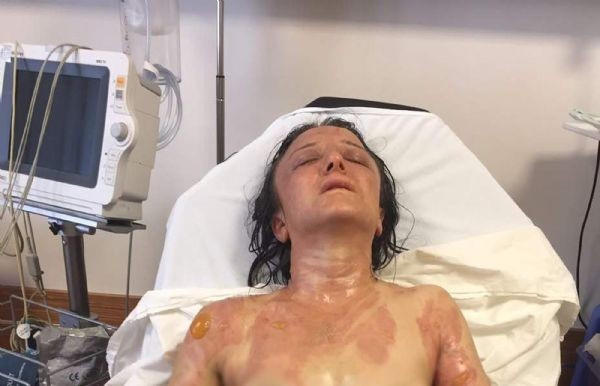 Kaynana dehşeti! Gelinin yüzüne kızgın yağ döktü - Resim: 2