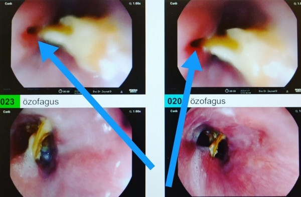 Mardin'de göğsünde yanma oluyordu! Gerçek doktora gidince ortaya çıktı: Birden bire böyle oldu - Resim: 0