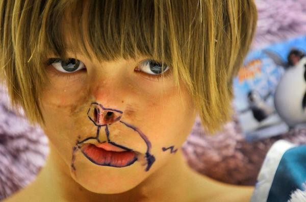 3 aylıkken yüzünü rakun parçaladı 11 yıl sonra ise... - Resim: 3