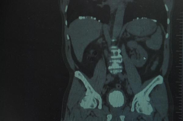 Elazığ'da adamın mesanesinden çıkan şey doktorları şoke etti! - Resim: 4