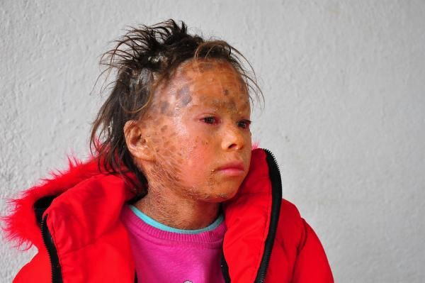 Doğduğu gün yoğun bakıma alındı! Balık pulu hastası Zahide günden güne eriyor - Resim: 1