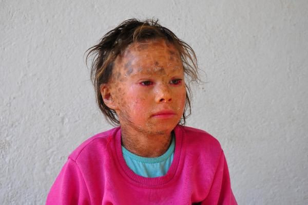 Doğduğu gün yoğun bakıma alındı! Balık pulu hastası Zahide günden güne eriyor - Resim: 2