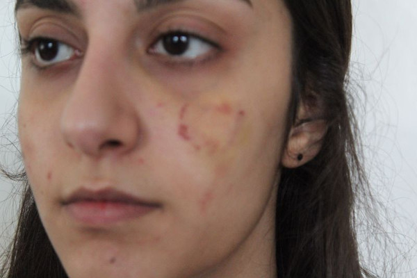 Gaziantep'te cenaze dehşet! Halası yüzünü ısırdı kaşları yırtıldı: Özel bölgelerimi açamadım - Resim: 2