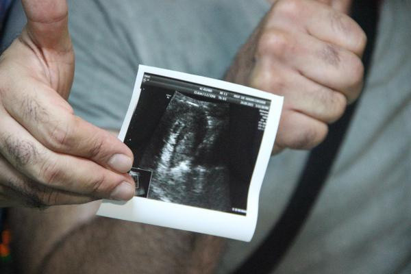 Fransa'da olmaz denildi! Diyarbakır'da müjdeli haberi aldılar - Resim: 1