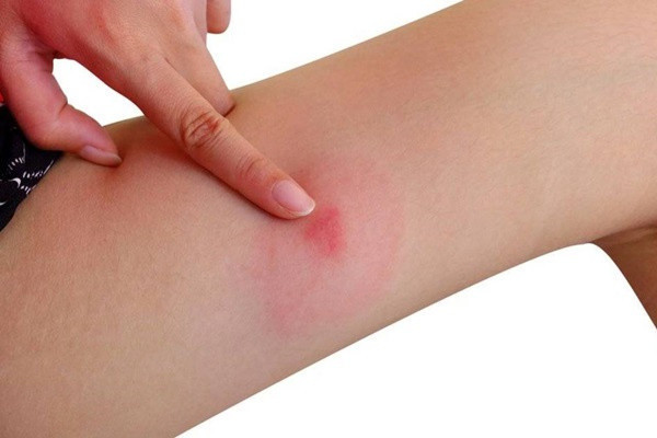 Kahrolası sivrisineklerle başınız dertte mi? Bu yöntemler sivrisinek ısırığına çok iyi geliyor - Resim: 0