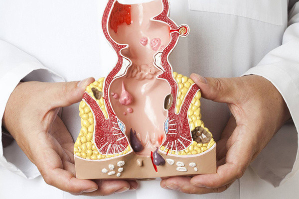 Hemoroid ile başınız dertteyse bu yöntemleri mutlaka deneyin! En etkili doğal ilaçlar - Resim: 0