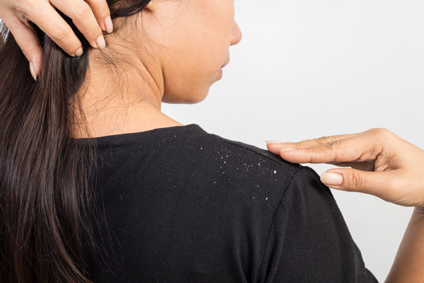 Birçok insanın başının belası, hatta saçının belası kepek... Bu alışkanlıklara sahipseniz kepek beşinizi bırakmaz - Resim: 0