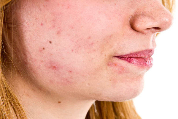 Bu yöntemler 1 haftada bütün sivilceleri kurutuyor! sivilcelerinizle başınız dertteyse bunları mutlaka deneyin - Resim: 0