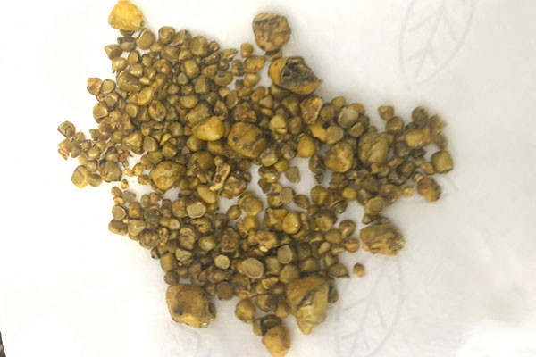 Şeker hastalığı için kontrole gitmişti! Midesinden çıkanlar şaşkına çevirdi - Resim: 1