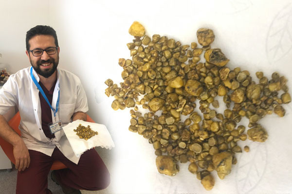 Şeker hastalığı için kontrole gitmişti! Midesinden çıkanlar şaşkına çevirdi - Resim: 2