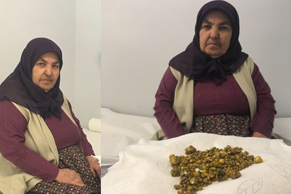 Şeker hastalığı için kontrole gitmişti! Midesinden çıkanlar şaşkına çevirdi - Resim: 4