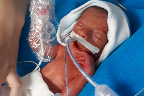 700 gram doğdu mucizevi şekilde hayatta kaldı son hali inanılmaz - Resim: 1