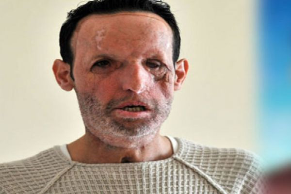 Yüz nakilli Recep Sert'ten kötü haber! Eşi Esma Sert açıkladı - Resim: 2