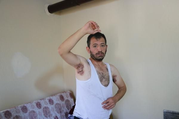 Eşim bile benden tiksiniyor dedi Niğde'de 'köpek memesi' hastası Enver'in çaresizliği! - Resim: 1