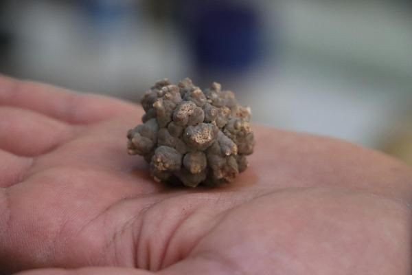 Doktorun şaşırtan böbrek ve idrar taşı koleksiyonu! Kimisi 22 santim, kimisi 650 gram - Resim: 2