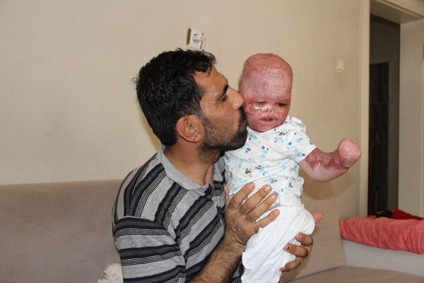 'Yüzde 90 yaşamaz' denildi! Mersin'de 2 yaşındaki bebek doktorları bile şok etti - Resim: 3