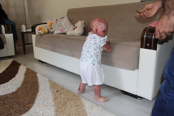 'Yüzde 90 yaşamaz' denildi! Mersin'de 2 yaşındaki bebek doktorları bile şok etti - Resim: 4